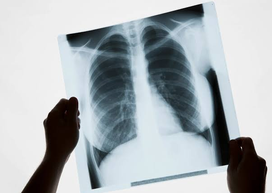 Deux mains tenant un cliché de radiographie du thorax face à la lumière.
